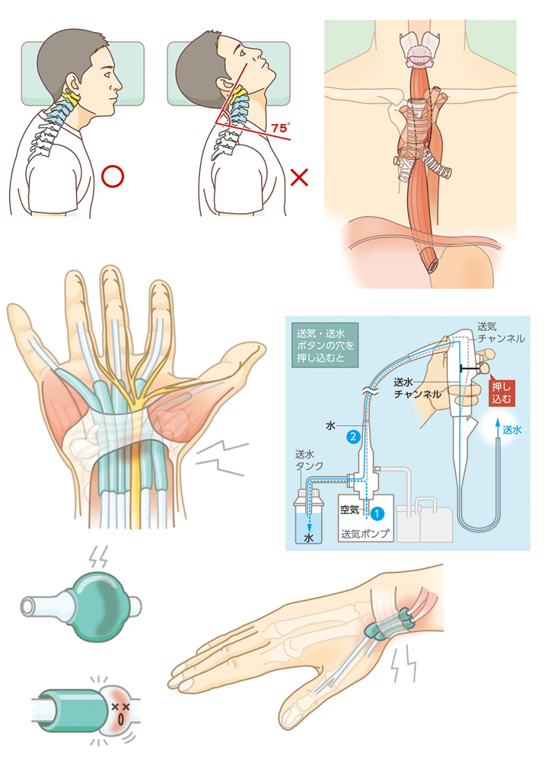 医学イラスト